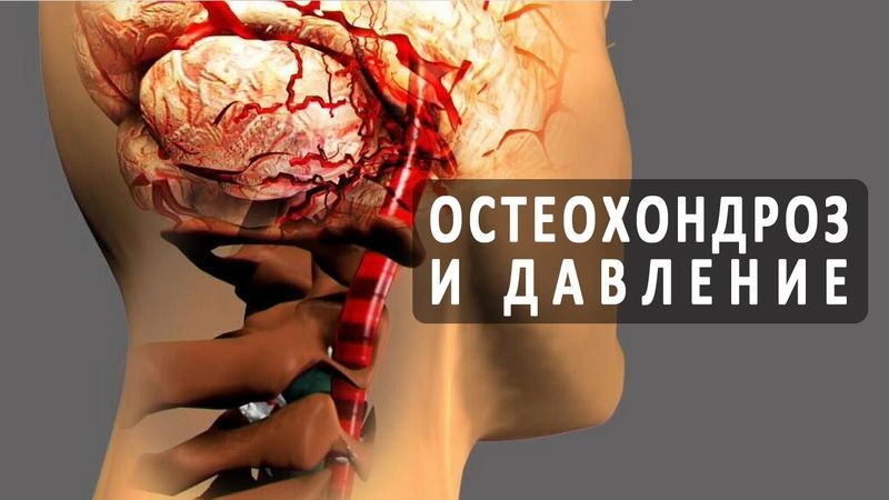 сахар при шейном остеохондрозе фраза просто бесподобна